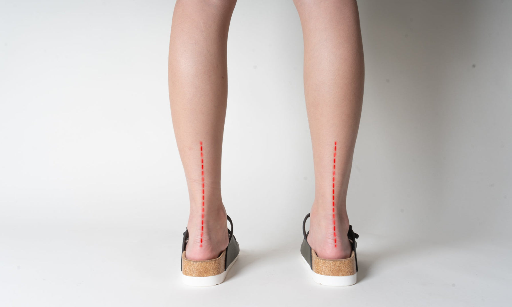 The same person standing with S-Care sandals, showing improved posture and support.