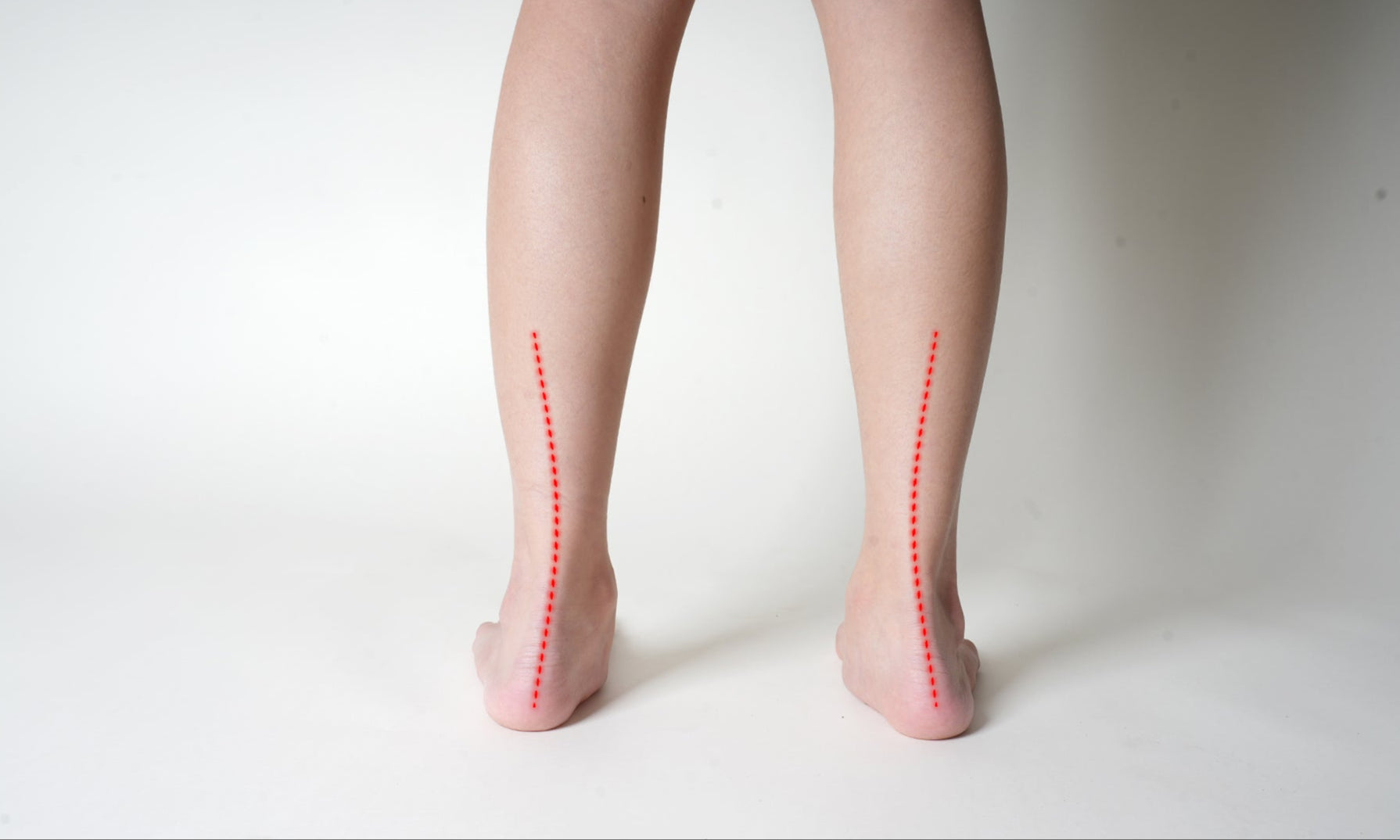A person standing without S-Care sandals, showing their natural foot posture.